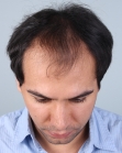 Before Hair Transplant&nbsp;Front